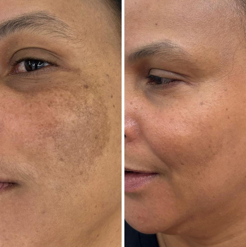 Linnea Andersson – results over 5 months (5 progress stages shown)