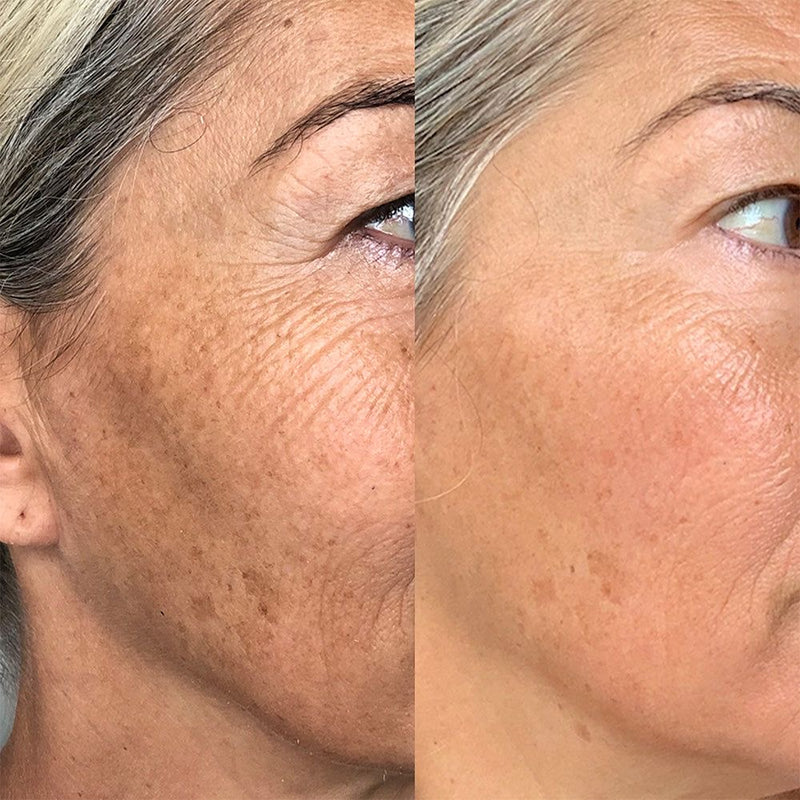 Tilde Svensson – smoother skin after 45 days
