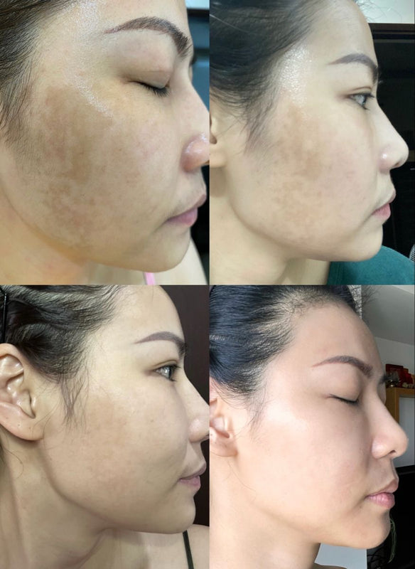 Elin Karlsson– smoother skin after 45 days