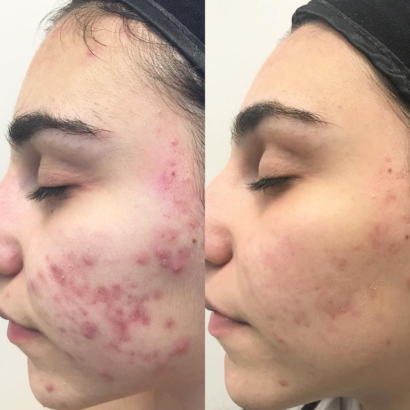 Lovisa Bergman – visibly calmer skin within 28 days
