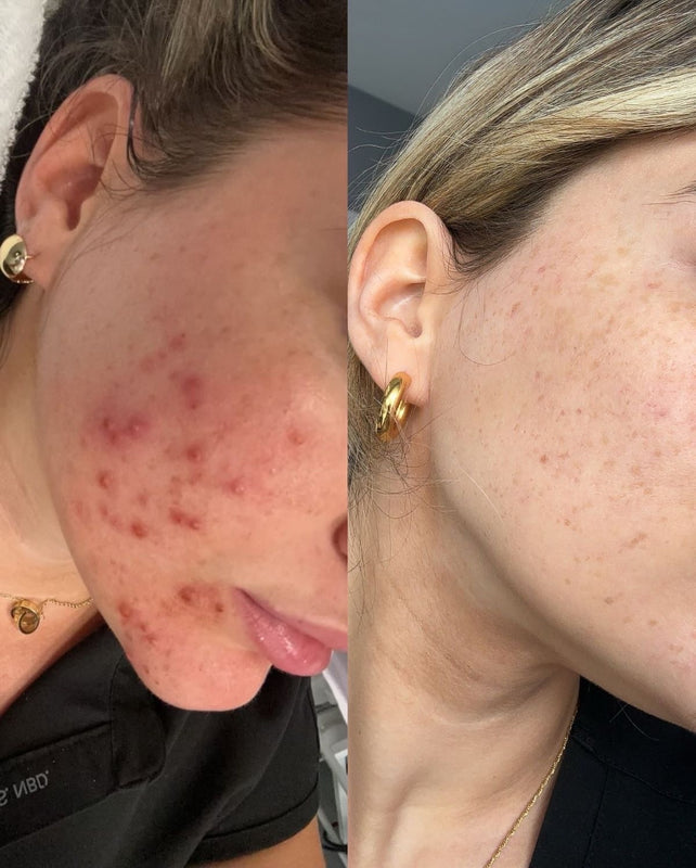 Lisa de Vries – een stralende en evenwichtige teint binnen 5,5 week