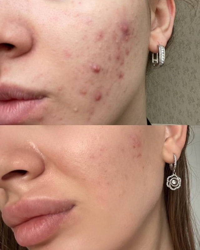 Sanne Jansen – een heldere en gezonde huid binnen 4 weken